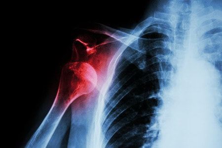 shoulder dislocation